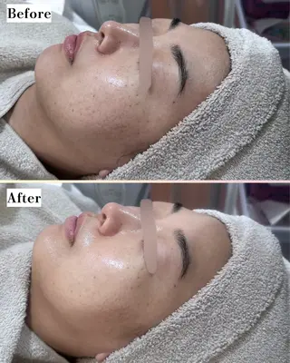 |ピーリング・毛穴| soina神楽坂のエステ・リラクイメージ