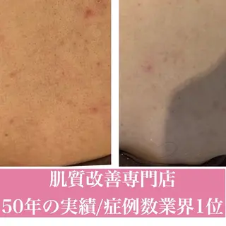 学生ニキビ改善🍀 優しい肌質改善のエステ・リラクイメージ