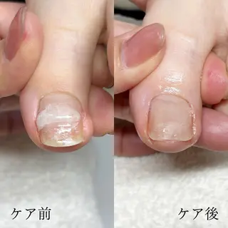 ネイル 深爪・巻き爪 専門サンセリテのネイルデザイン