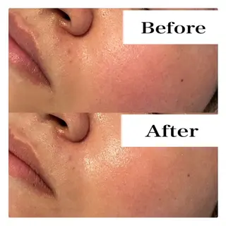 ハーブピーリング LIME池袋東口のエステ・リラクイメージ