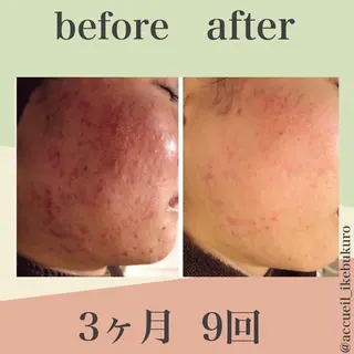 🔥3か月で肌革命 🔥ニキビ専門店のエステ・リラクイメージ