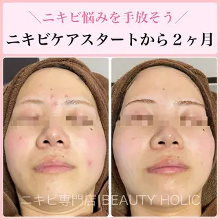 ニキビ・ 肌荒れ専門店のエステ・リラクイメージ