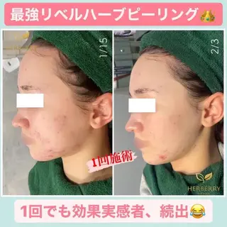 ハーブピーリング専門店HERBERRY難波心斎橋店所属・ハーブピーリング専門 HERBERRY冨永のエステ・リラクイメージ