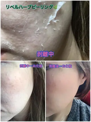 【リベルハーブピーリング認定店】敏感肌・美白脱毛専門店Dione立川店所属・Dione 立川店のエステ・リラクイメージ