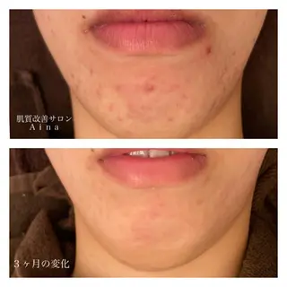 ロング カラー パーマ ヘアアレンジ メンズ キッズ ネイル マツエク・マツパ ニキビ跡専門サロン Ａｉｎａのエステ・リラクイメージ