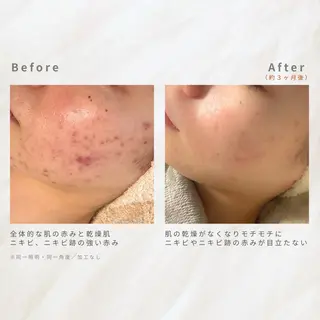 繰り返すニキビを改善 ✨つくば肌質改善専門のエステ・リラクイメージ