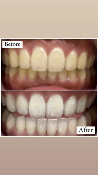 LBSホワイトニング 🌐渋谷店 小河原のエステ・リラクイメージ