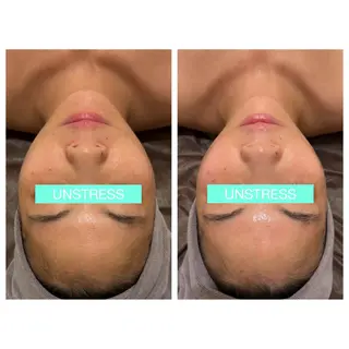 ☆痩身/小顔☆ ハイパーナイフexのエステ・リラクイメージ