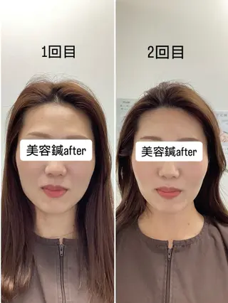 hari salon de off 美容鍼灸×小顔整体【ハリサロンドオフ】所属・美容鍼灸×小顔整体♡ ハリサロンドオフ堺東のエステ・リラクイメージ