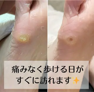 深爪・巻き爪 専門サンセリテのネイルデザイン