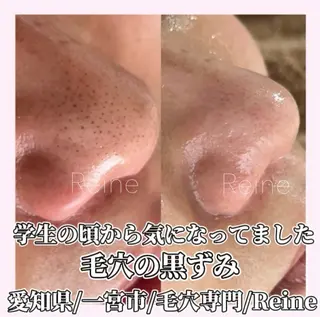 Reine BeautySalon所属・毛穴/シミ肝斑/脱毛 横山梨里のエステ・リラクイメージ