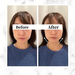 12Dハイフ💗 最強小顔のエステ・リラクイメージ