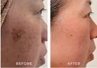 毛穴ケア くすみ肌 ハーブピーリングのエステ・リラクイメージ