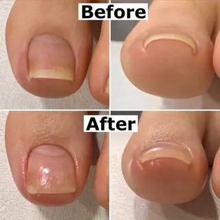 ネイル Mellow nail所属・巻爪無料モデル募集 ✨🦶MEGUMIのネイルデザイン