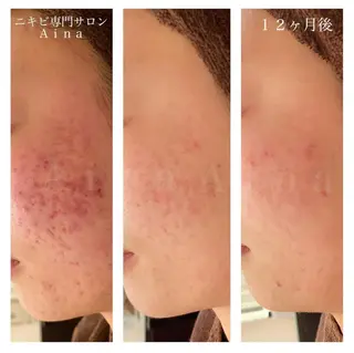 ショート カラー パーマ ヘアアレンジ メンズ キッズ ネイル マツエク・マツパ アイブロウ ニキビ跡専門サロン Ａｉｎａのエステ・リラクイメージ