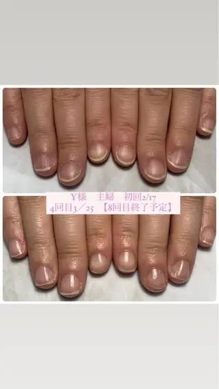 ネイル 自爪育成/深爪矯正 mikiのネイルデザイン