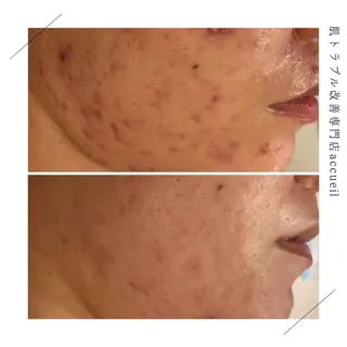 セミロング カラー パーマ ヘアアレンジ メンズ キッズ ネイル マツエク・マツパ アイブロウ 触れたくなる モテ肌へ...❤︎のエステ・リラクイメージ