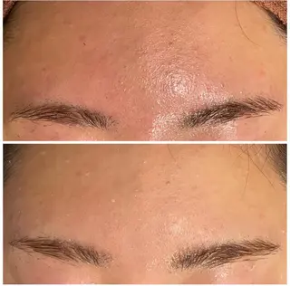 ニキビ跡改善専門🔥 医療にはできない改善のエステ・リラクイメージ