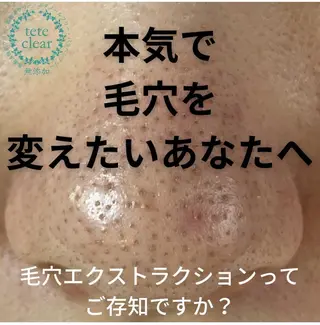 毛穴黒ずみ改善🥇 ✨シフォン豊田✨のエステ・リラクイメージ