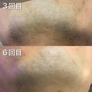 脱毛サロン NR エヌアール所属・NR Nara yukiのエステ・リラクイメージ