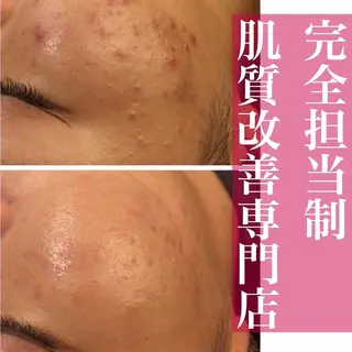 都内で出来る肌管理！ 最短ニキビ改善のエステ・リラクイメージ