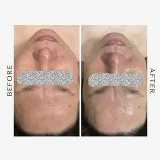 メンズ 頭蓋骨小顔矯正 ハーブピーリングのエステ・リラクイメージ