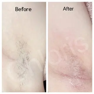 川越ローマピンク 光脱毛＆ワックス脱毛のエステ・リラクイメージ