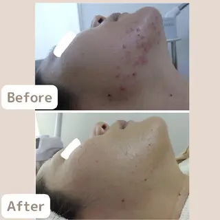 メンズ ニキビ,ニキビ跡/ レチノールケア/浅川のエステ・リラクイメージ