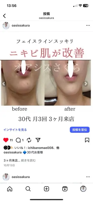 オアシス・さくら所属・小顔（シミ ニキビ）脱毛サロンのエステ・リラクイメージ