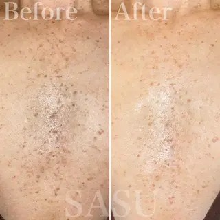 メンズ 即小顔♥️美容鍼× ハーブピーリングのその他イメージ