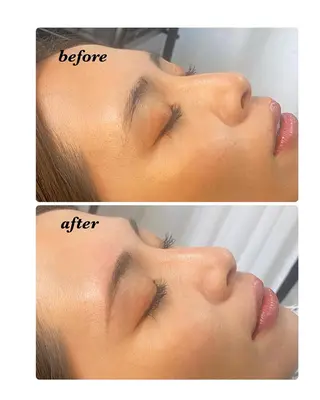 アイブロウ ハーブピーリング/韓国肌管理/フェイシャル/毛穴洗浄/眉毛/顔脱毛【糸脱毛専門】rev所属・ハーブピーリング🌹 毛穴洗浄❤️眉waxのエステ・リラクイメージ