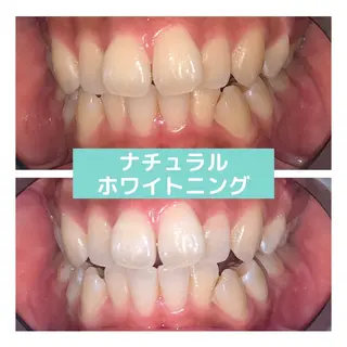 ホワイトニング|韓国式3D毛穴洗浄 lonhana ロンハナ所属・韓国式3D毛穴洗浄 lonhanaのその他イメージ