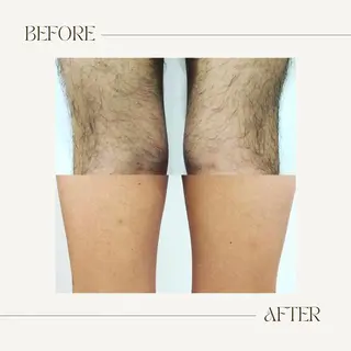 脱毛専門サロンELIXIR（ｴﾘｸｻｰ）所属・脱毛&ホワイトニング ELIXIR×ULTのエステ・リラクイメージ