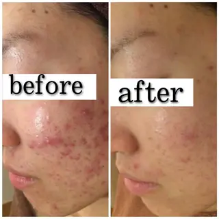 セミロング カラー パーマ ヘアアレンジ メンズ キッズ ネイル マツエク・マツパ アイブロウ ニキビ特化型エステ 🍓最短で肌質改善のエステ・リラクイメージ