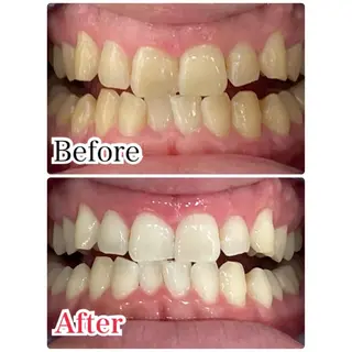 セミロング メンズ キッズ ネイル プラチナムビューティー柏所属・【歯科提携】柏ホワイ トニングスタイルのその他イメージ