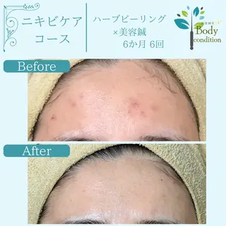 小顔ハーブピーリング 美容鍼/毛穴洗浄のエステ・リラクイメージ