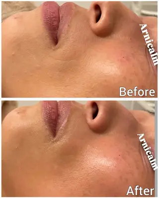 ハーブピーリング 肌再生ピーリング/のエステ・リラクイメージ