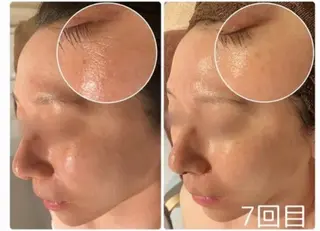 ニキビ･毛穴悩み特化 /CHISATOのエステ・リラクイメージ