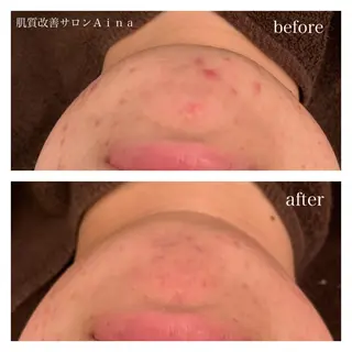 ショート カラー パーマ ヘアアレンジ キッズ ネイル マツエク・マツパ ニキビ跡専門サロン Ａｉｎａのエステ・リラクイメージ