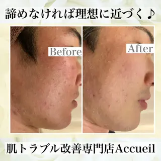 ミディアム カラー パーマ ヘアアレンジ メンズ キッズ ネイル マツエク・マツパ ニキビ・肌質改善専門 ♡人生が変わるサロンのエステ・リラクイメージ