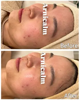 ハーブピーリング 肌再生ピーリング/のエステ・リラクイメージ