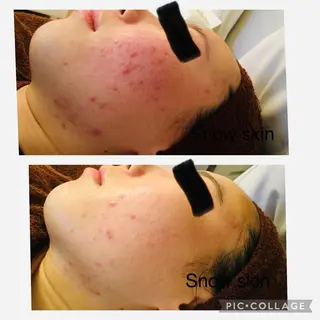 ニキビ/肌質改善専門 Snow skinのエステ・リラクイメージ