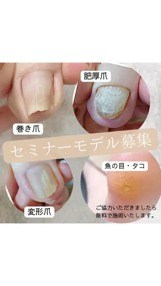 ネイル 深爪・巻き爪 専門サンセリテのネイルデザイン