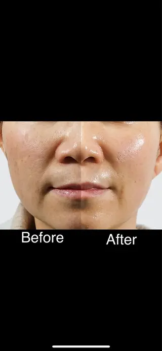 くすみ・シミ改善/ ララピール/光フォトのその他イメージ