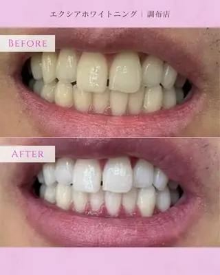 エクシアホワイト調布所属・umi❤︎ ホワイトニングのその他イメージ