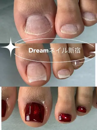 ネイル フィルイン、長さ出し 深爪矯正のネイルデザイン