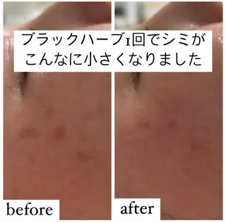 【ハーブピーリング】 Allumentのエステ・リラクイメージ