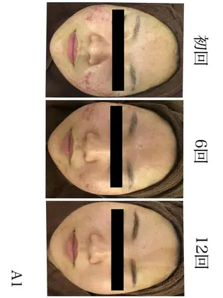 🔥3か月で肌革命 🔥ニキビ専門店のエステ・リラクイメージ