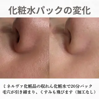 重度ニキビ専門🌷 ダウンタイムなしのエステ・リラクイメージ