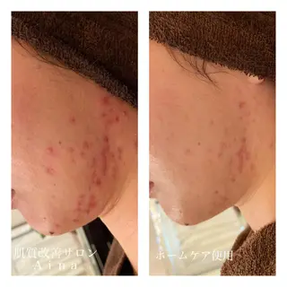 ロング カラー パーマ ヘアアレンジ メンズ キッズ ネイル マツエク・マツパ ニキビ跡専門サロン Ainaのエステ・リラクイメージ